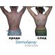 ДермаСпрей Интензив (DermaSpray Intensive) спрей при проблемна кожа